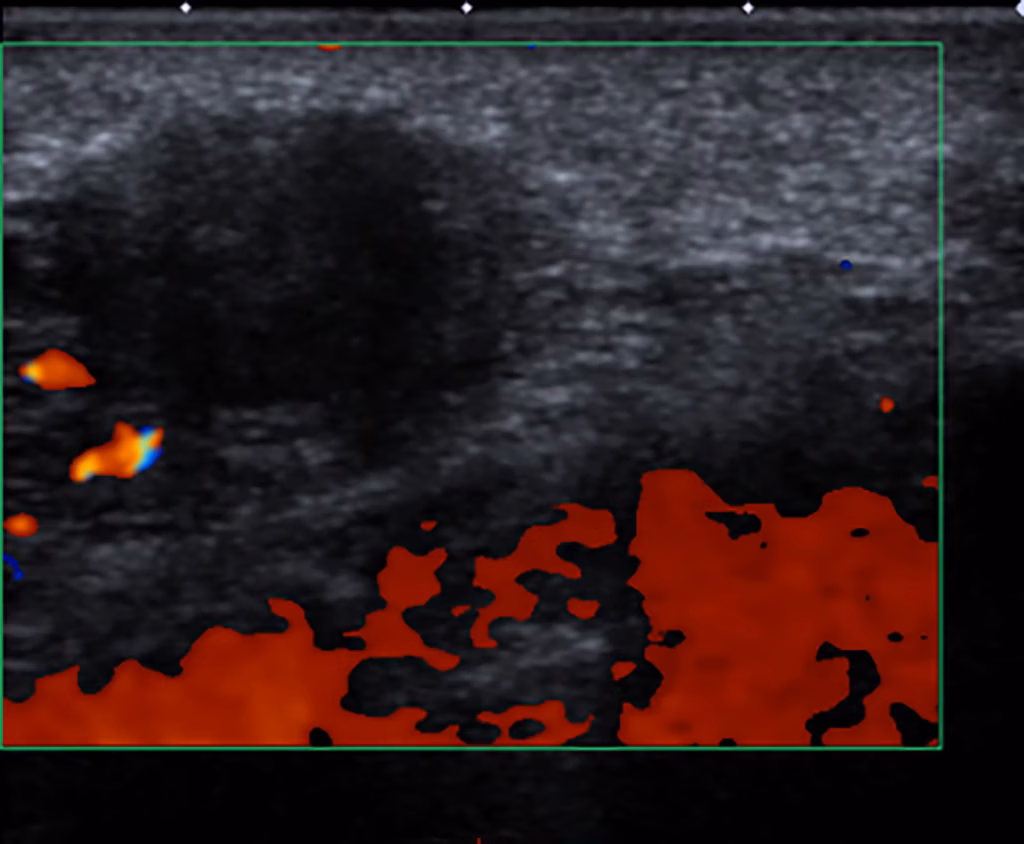 Figure 4: Ultrasound Imaging of breast -categorized as BIRADS score IV C showing